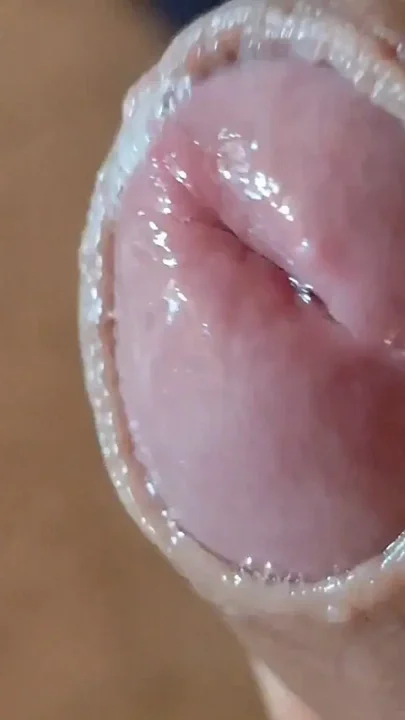 Deep Split in the Glans Produces Bubbling Liquid