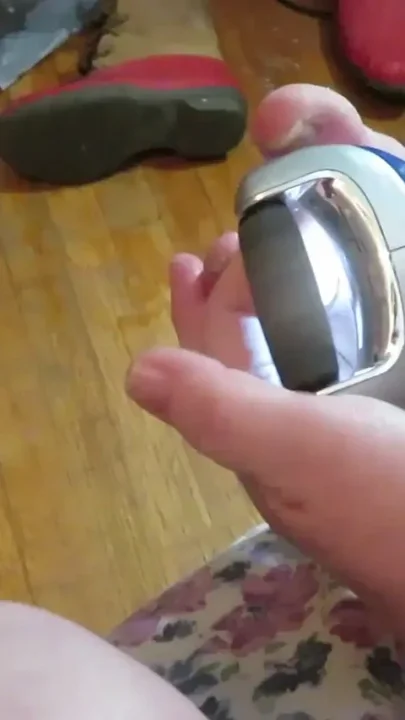 Nurse Vicki grinds her toe nails down with her electric Pedi egg tool Poor ugly