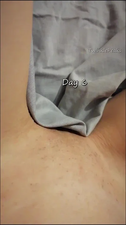 Pussy Hair Growth after deep bikini sugar wax
