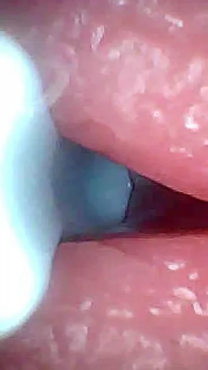 I Couldnt Believe What Happens Inside the Penis as Sperm Passes Through endoscopic Footage