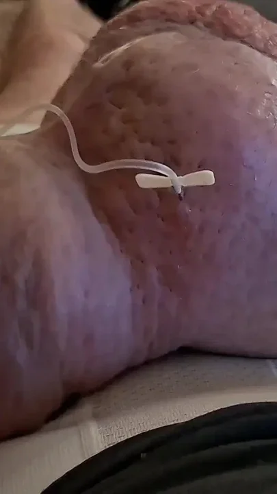 Extreme Fillings Inside My Siliconemeat