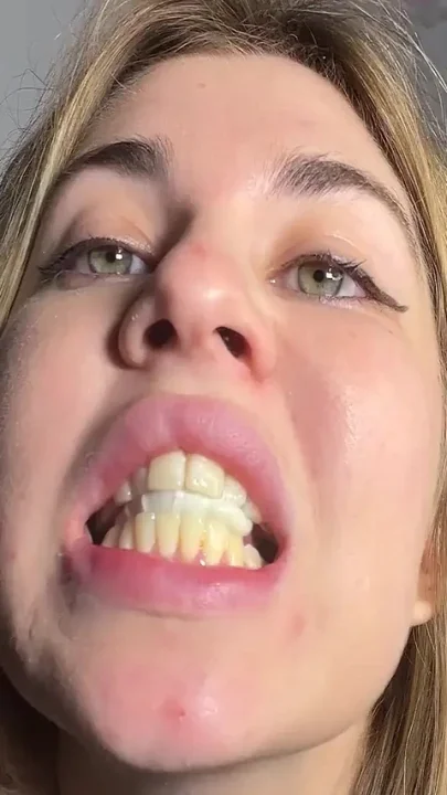 A Close up View of Mouth Gum and Drooling