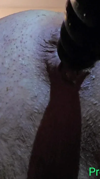 Closeup Anal Prolapse with Inflatable Buttplug