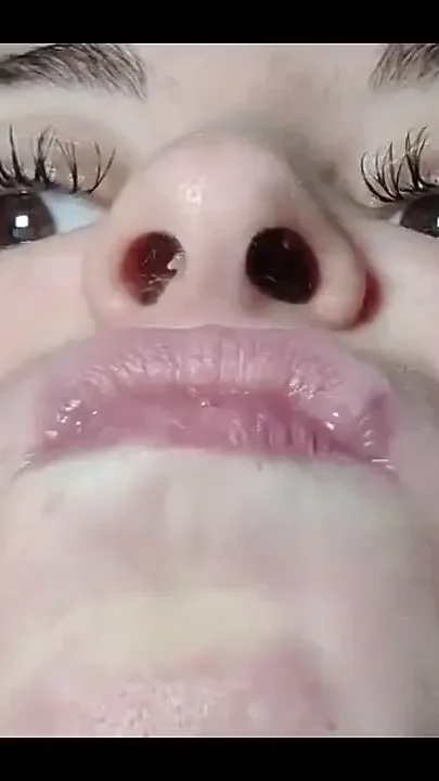 My Nose with Snot up Close