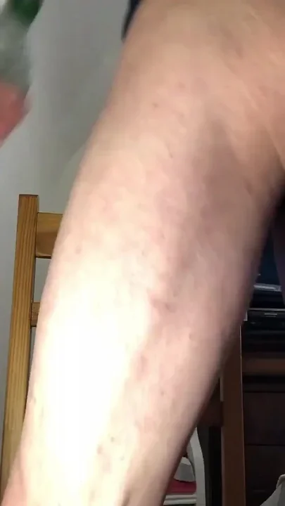 Impressive Anal Dilatation After Harsh Insertion