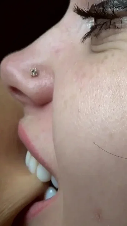 Hard biting of male fingers and arm
