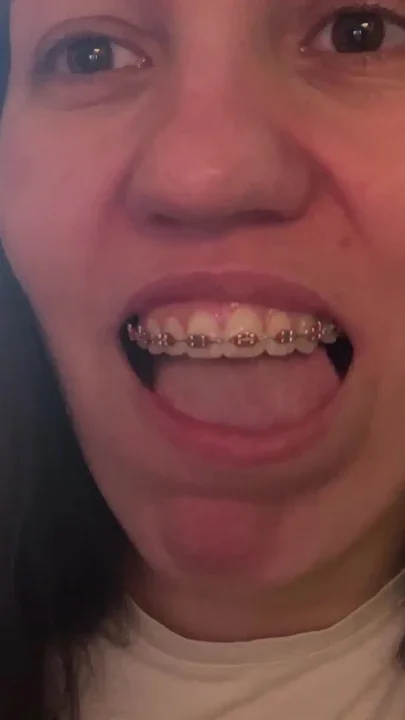 Licking Your Braces with Your Tongue