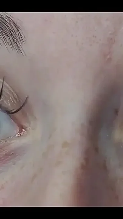 Crossing the Eyes