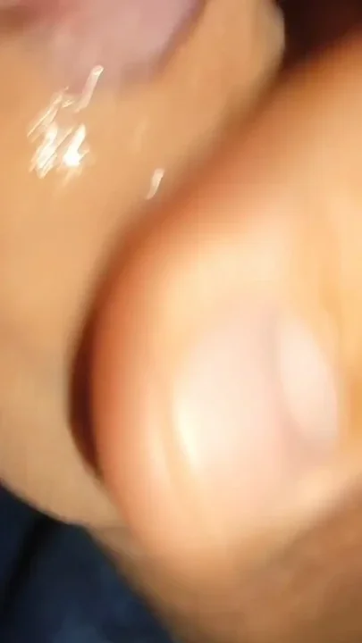 Difficult Fluid Control Due to Straight Phimosis