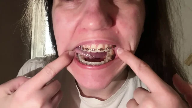 Licking Your Braces with Your Tongue
