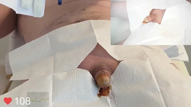 Close-Up insertion of a 16 French foley catheter